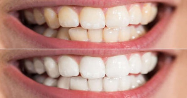 Dankzij dit wondermiddel kun je afscheid nemen van lelijke gele tanden!